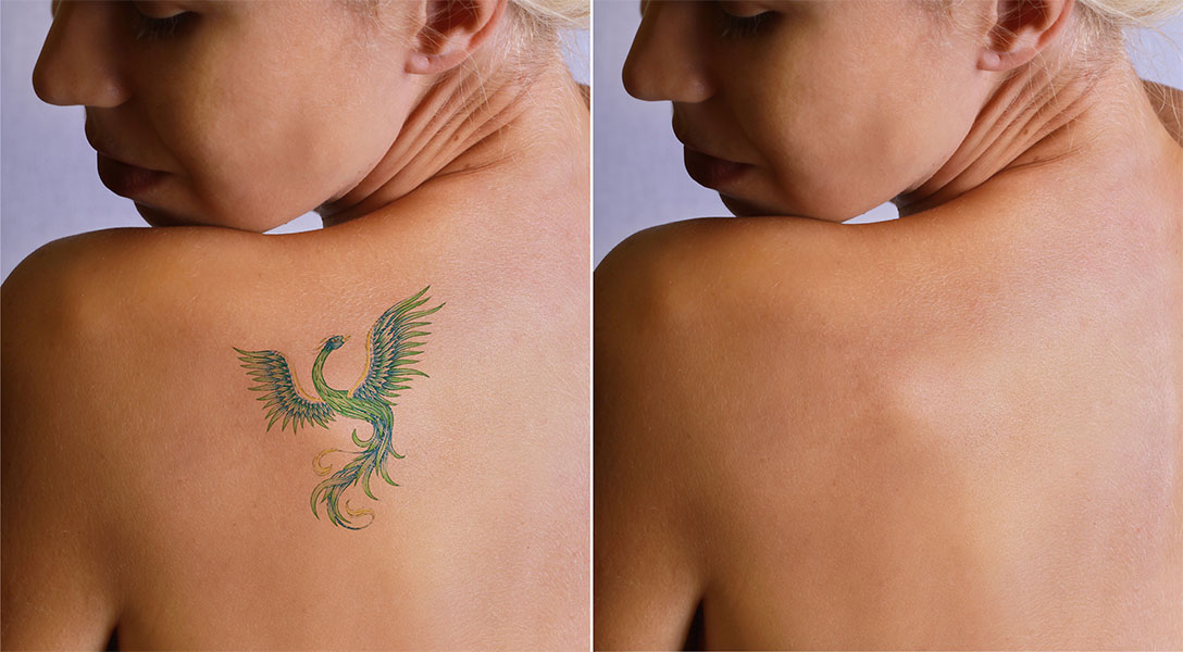 Tattoo Removal — All Over Beauty & Medi Span In Forresters Beach, NSW